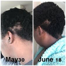 This hair growth serum has been shown to thicken hair by up to 150 percent! Bald Patch Finally Growing Back Hair Growth Foods Rapid Hair Growth Hair Growth Secrets