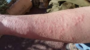 Image result for contact dermatitis