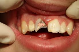 Every time you drink soda, these two components interact with the bacteria in your mouth. Chipped Tooth Or Broken Tooth Glow Dental Provide A Resolution For You