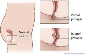 Image result for Rectal Prolapse