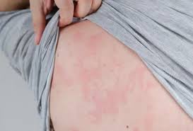 Image result for Exercise-Induced Anaphylaxis