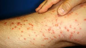 Image result for allergy rash on the legs