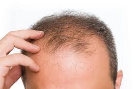 Alopecia Areata Panosundaki Pin