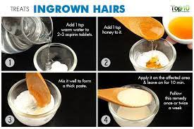 This phenomenon occurs mainly when you are shaving or using incorrect hair removal remedies or cosmetics. Aspirin Paste For Ingrown Hair Ingrownhairsevere Ingrown Hair Ingrown Hair Removal Treat Ingrown Hair