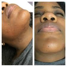 The ancient art of sugaring removes the hair in its natural growth pattern serving as an ingrown hair solution. 22 Best Sugaring Hair Removal Before And After Ideas Sugaring Hair Removal Sugaring Hair Removal