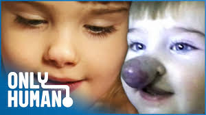 Real Life 'Pinocchio Girl' Has Nose That Is Constantly Growing