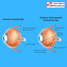 Image result for Eye Pain