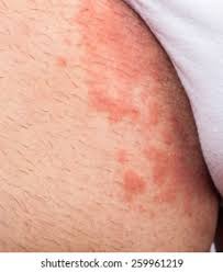 Image result for sore skin in the groin area