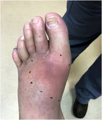 Image result for Septic Joint