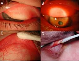 Image result for Eye Foreign Body