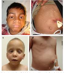 Treatment for naegeli syndrome is based on an individual's symptoms. Naegeli Syndrome Semantic Scholar