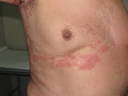 Între timp, acest tip de virus nu numai afectează buzele, așa leziuni herpetice pe buze foto herpes nas fotografie herpes pe ochi fotografie. Cauzele È™i Metodele De Tratament Pentru Herpes Zoster De Ce Apare Herpesul Pe Stomac De Ce Apare Herpesul Pe Stomac