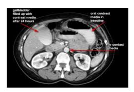 Image result for CT Intravenous Contrast