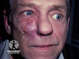 Image result for Tertiary Syphilis