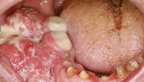 Image result for dental cancer