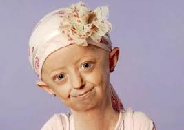 Brocklehurst's textbook of geriatric medicine and gerontology, seventh edition. Hayley Okines Dies From Rare Premature Aging Disease Aged 17