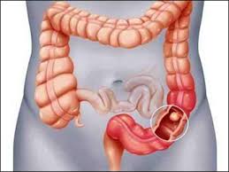 I went to the gp and complained about this but it was just passed off as severe ibs and they said i was too young to get bowel cancer. How To Treat Colorectal Cancer Colon Cancer Naturally Ayurvedic Treatment