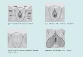 Alle praktiken die nicht typ i, ii oder iii zugeordnet werden können. Protecting Students From Female Genital Mutilation British Journal Of School Nursing