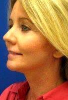 16:55 et, jun 9 2021; Lifestyle Lift Cost And Reviews Facelift Info Prices Photos Reviews Q A