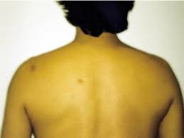 If you get a graze, treat the wound at home first. The Back Of The Patient Showing Evidence Of 2 Scars The Scar Over The Download Scientific Diagram