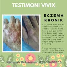 Kulit kepala aryan adalah area paling teruk yang di attack oleh eczema. Klinik Pakar Kulit Eczema Shah Alam