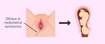 What is Episiotomy and How Can It be Prevented?