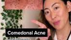 Types of #acne and #acnetreatment #muradpartner ...