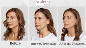 Apr 06, 2022 · before and after sculptra® aesthetic | lexington dermatology and laser center individual results and treatment sessions may vary. Sculptratreatment Deja Vu Med Spa Sculptra Near Me