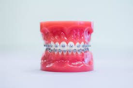 My whole life i had a big gap in my teeth and i didnt like to smile or talk to people. The Role Of Spacers And Rubber Bands In Orthodontic Work