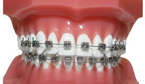 We did not find results for: Braces Before And After What To Expect Splash Orthodontics