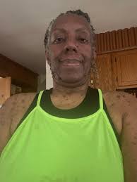 Morning my name is Maggie i had surgery last week for 2 nf1 lumps removed  from my hand hope it heels better then it looks