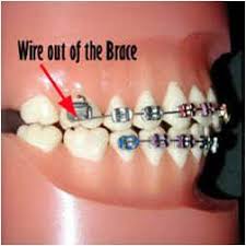 I had nothing else at the time and i used my nail clipper. Cronauer Angelakis Orthodonticsdamaged Braces We Can Help Cronauer Angelakis Orthodontics