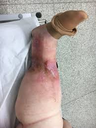 Image result for erysipel photos)