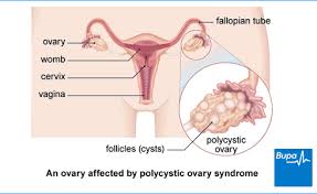 Lifestyle modiﬁcation, nutrition, polycystic ovarian syndrome. Polycystic Ovary Syndrome Health Information Bupa Uk
