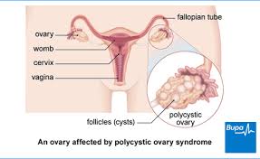 How does a hormone test help inform a pcos diagnosis? Polycystic Ovary Syndrome Pcos Symptoms And Treatments Bupa Uk