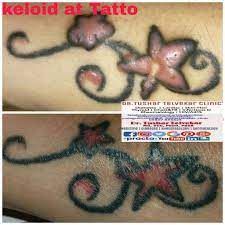 43 Year Female Post Menopausal Kc Of Htn On Medication Controlled H O Tattoo Drwan On Lt Hanf Near Wrist Joint Around 4 Year Back Back Tattoo Tattoos Keloid