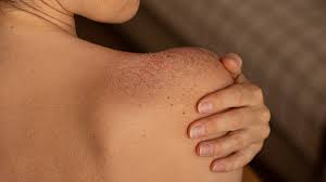 Image result for sweat rash on back