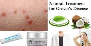 8 Natural Treatments For Grover S Disease At Home Grover Disease Natural Treatments Lyme Disease Symptoms
