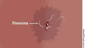 Albendazole (albenza) you may have mild gastrointestinal side effects during the course of treatment, and you often need to take at least two doses to get rid of the pinworms completely. Pinworm Infections For Parents Nemours Kidshealth