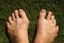 Comparison of Left Foot AP View 3D Rendering Image and X-ray Image. Stock  Photo