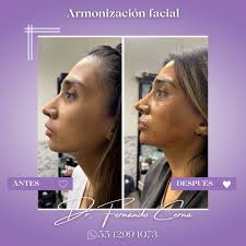 🌟 ¡Descubre la armonización facial con el Dr. Fernando Cerna! 🌟  Transforma tu apariencia y realza tu belleza natural con nuestros  tratamientos de armonización facial. En manos del Dr. Fernando Cerna,  obtendrás