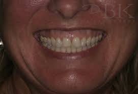 Do you feel conscious about a gummy smile? Gummy Smile Reduction At Drbk Aesthetics Clinic In Reading