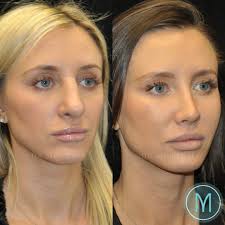 Gary Motykie Md Facs On Instagram Revision Rhinoplasty This 30 Year Old Patient That Underwent A Closed Rhinoplasty Rhinoplasty Nose Jobs Nose Job