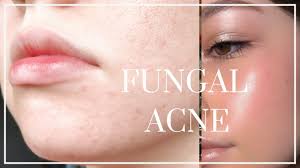 This will ensure you're always prepared for surprise skin conditions. How To Get Rid Of Fungal Acne Beat Tiny Bumps Youtube