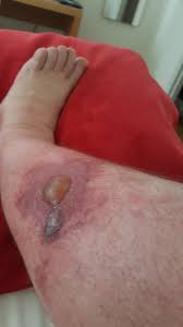 You may experience itching, redness, and swelling after a mosquito bite. Preventing And Treating Insect Bites Lupus Uk