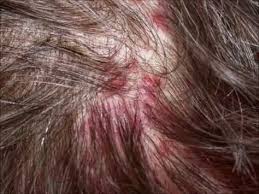 Sores On Scalp Scabs Itchy Painful Pictures Crusty Pimples On Scalp Acne Scalp Scabs Pimples On Scalp Sores On Scalp