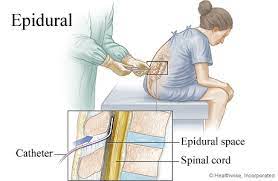 Ada kaitan ke mengambil suntikan epidural dengan sakit pinggang. Ubat Sakit Pinggang Selepas Bersalin Jurupulih Q
