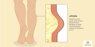 Lipoma Adalah Benjolan Lemak Yang Tumbuh Di Bawah Kulit Lipoma Dapat Menimbulkan Rasa Sakit Dan Biasanya Terjadi Di Leher Bah Penyakit Rasa Sakit Pengetahuan