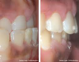 An underbite is a bite problem that occurs when the lower teeth rest further than the upper teeth. Underbite Treatments