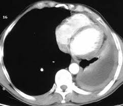 Typically, patients with pleural mesothelioma receive a ct of the chest with contrast dye. Mesothelioma Practice Essentials Background Etiology